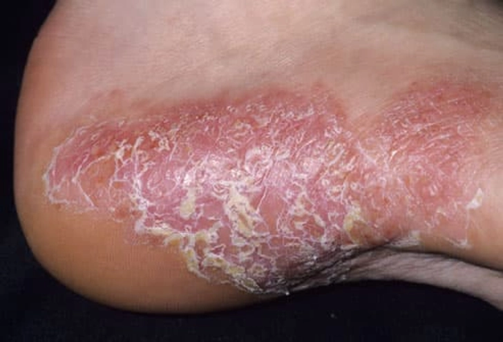 Pustular Psoriasis