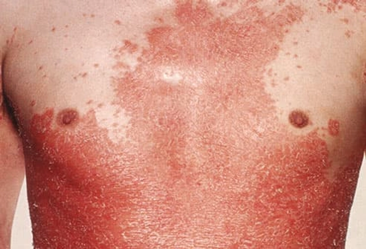 Erythrodermic, or Exfoliative