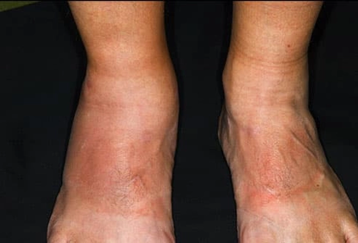 Psoriatic Arthritis