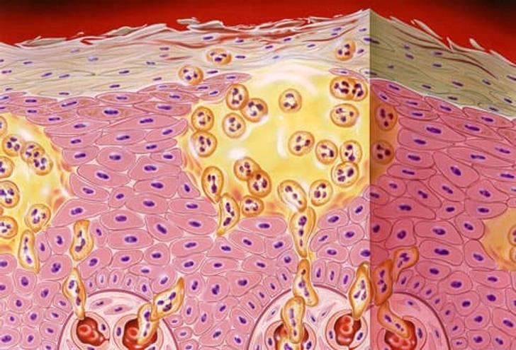 Pustular Psoriasis: Emergency Symptoms