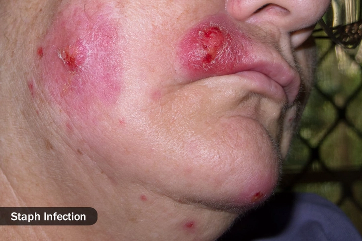 Skin Infections