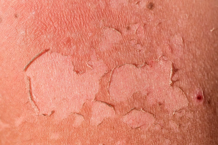 Sunburn
