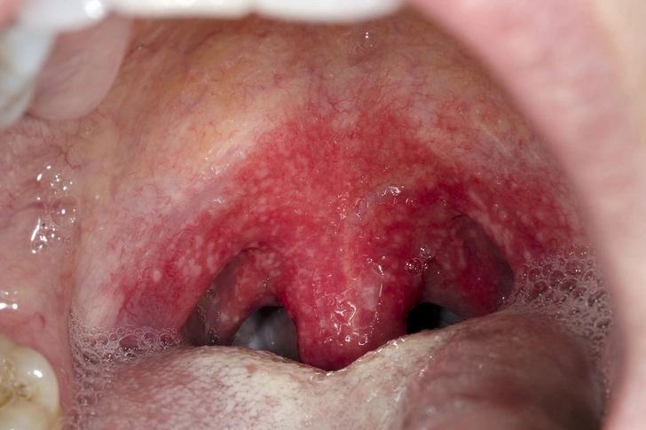 Strep Throat