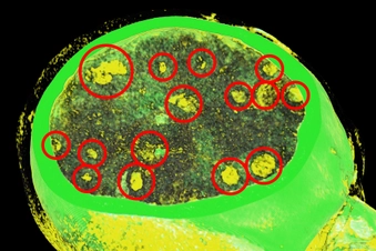 How Do I Know if My Cancer Has Spread?