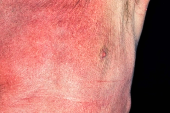 What Are the Side Effects of EGFR Inhibitors? What Are the Side Effects of EGFR Inhibitors?
