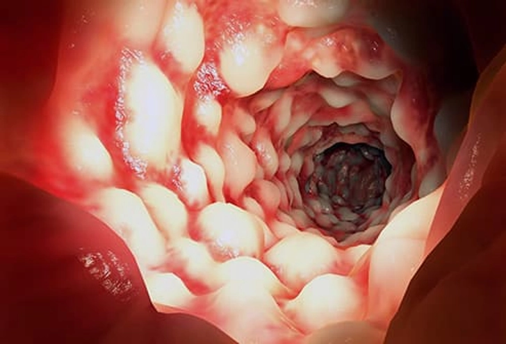 Inflammatory Bowel Disease (IBD) Inflammatory Bowel Disease (IBD)