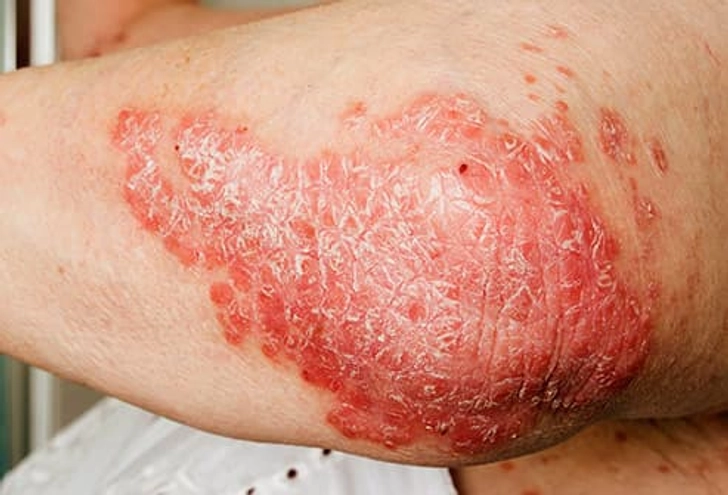 Psoriasis Psoriasis