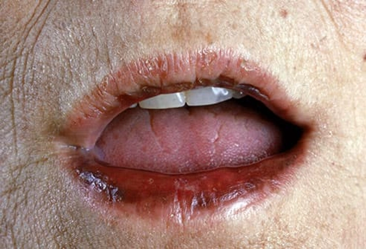 Addison’s Disease Addison’s Disease