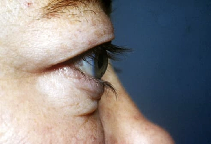 Graves’ Disease Graves’ Disease