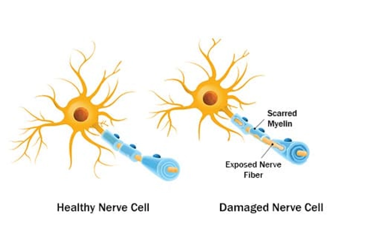 Multiple Sclerosis (MS) Multiple Sclerosis (MS)