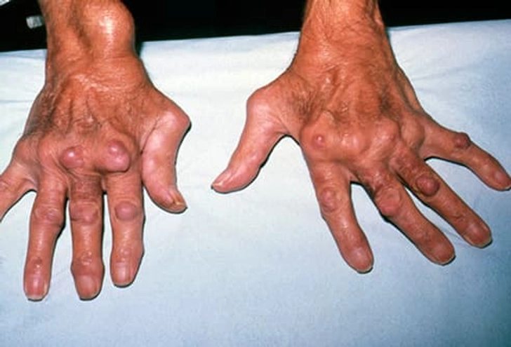 Rheumatoid Arthritis Rheumatoid Arthritis