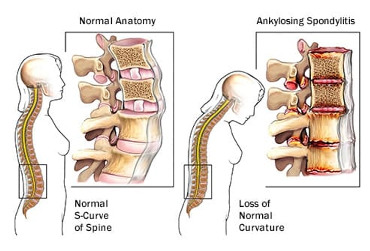 Ankylosing Spondylitis Ankylosing Spondylitis