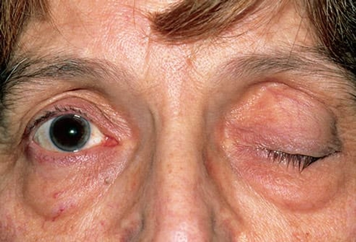 Myasthenia Gravis Myasthenia Gravis