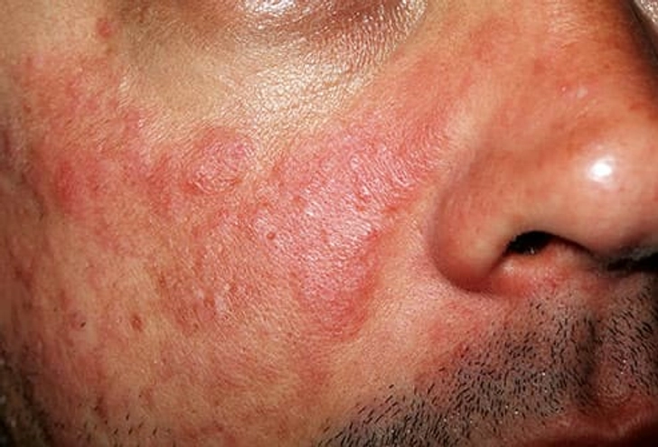 Lupus Lupus