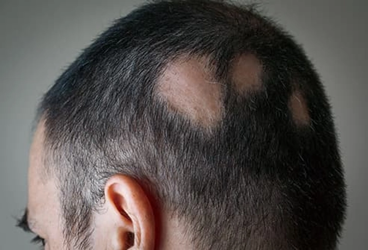Alopecia Areata Alopecia Areata