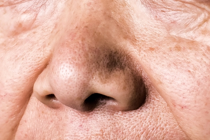 Poor Sense of Smell Poor Sense of Smell