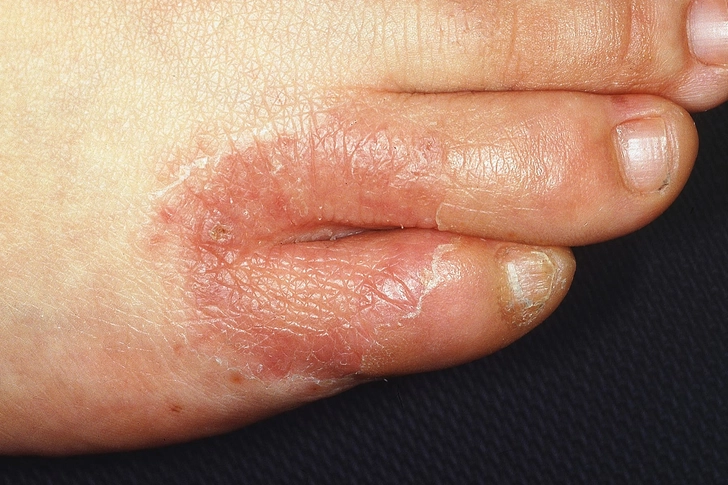 Athlete’s Foot