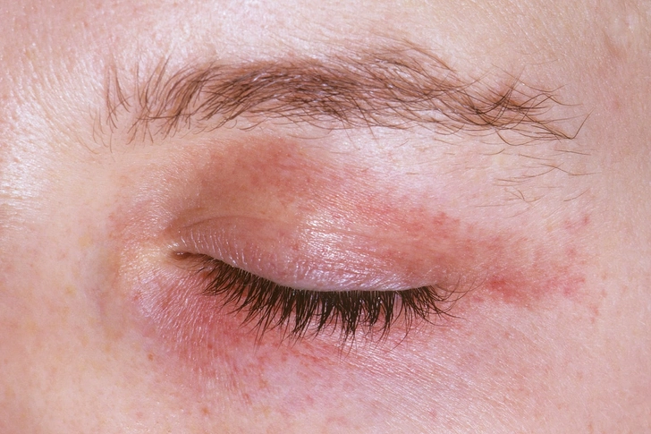 Amyloidosis