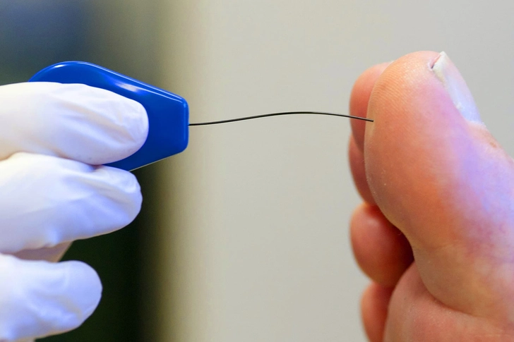 Peripheral Neuropathy