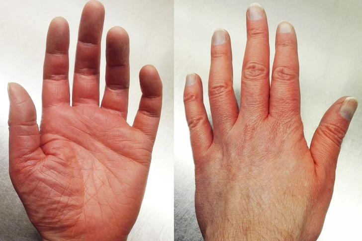 Erythromelalgia