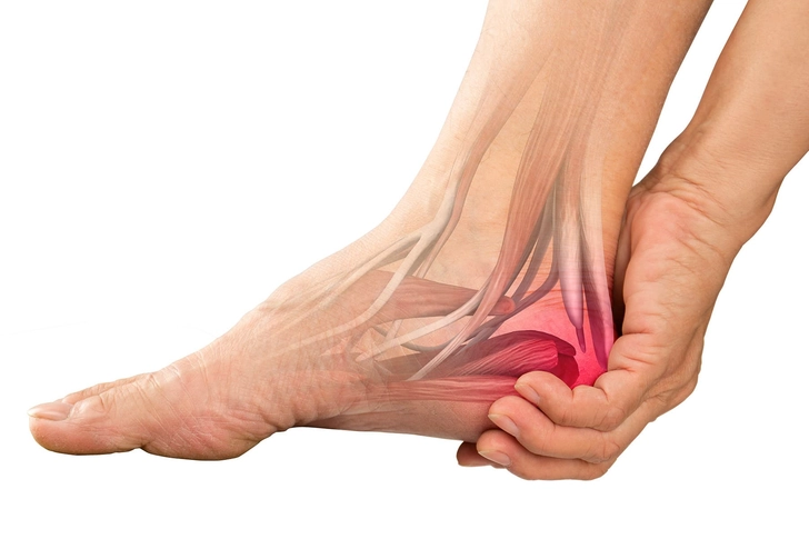 Tarsal Tunnel Syndrome