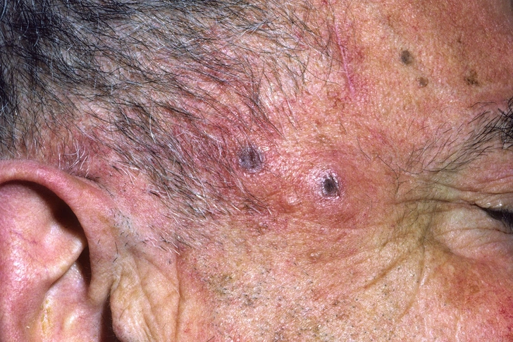 Giant Cell Arteritis