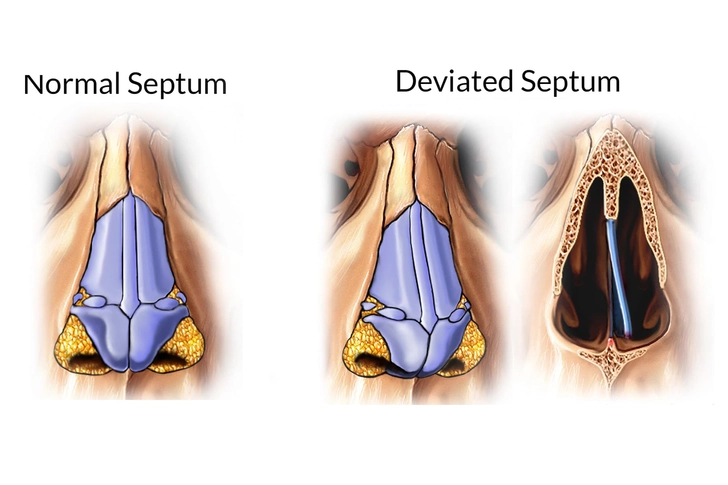 Deviated Septum