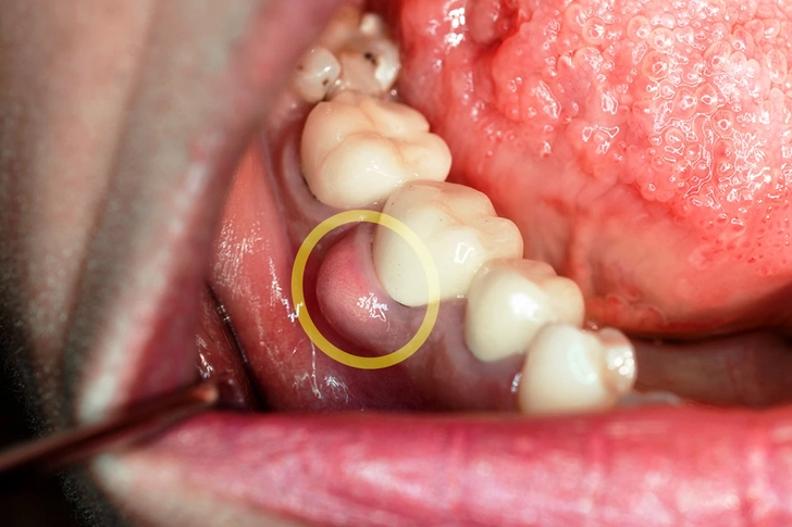 Abscessed Tooth