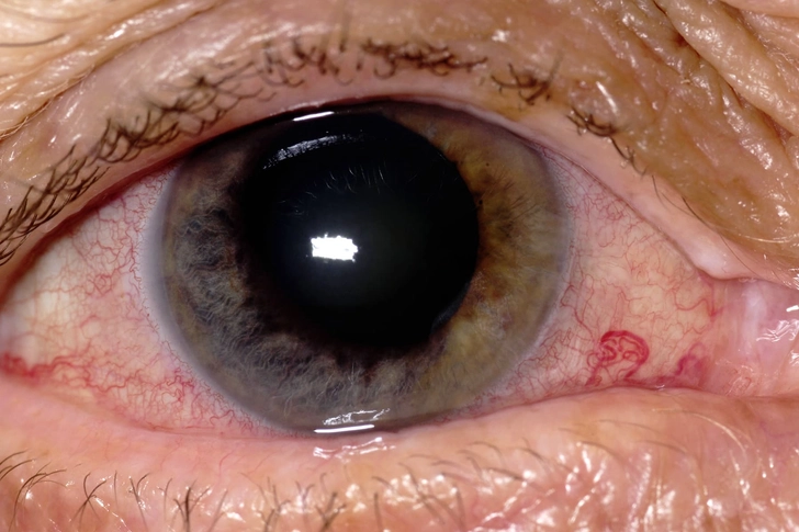 Acute Angle-Closure Glaucoma