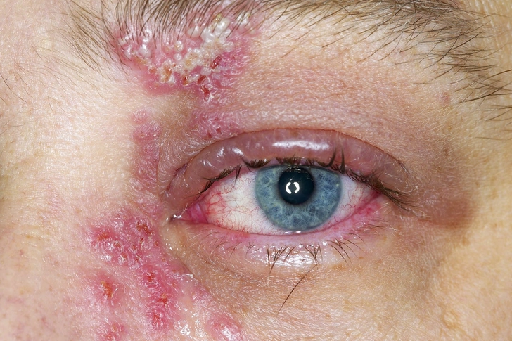 Shingles