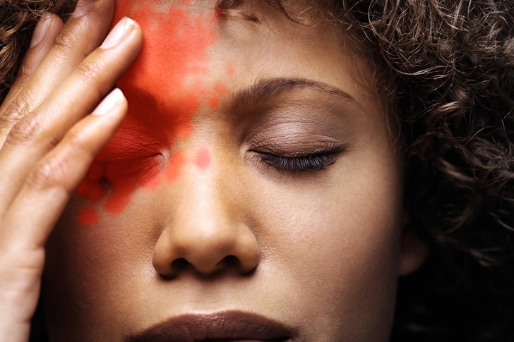 Cluster Headache