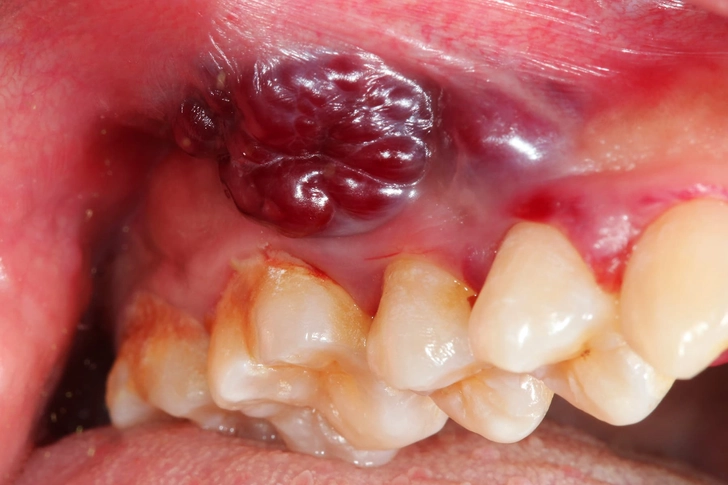Mouth Cancer