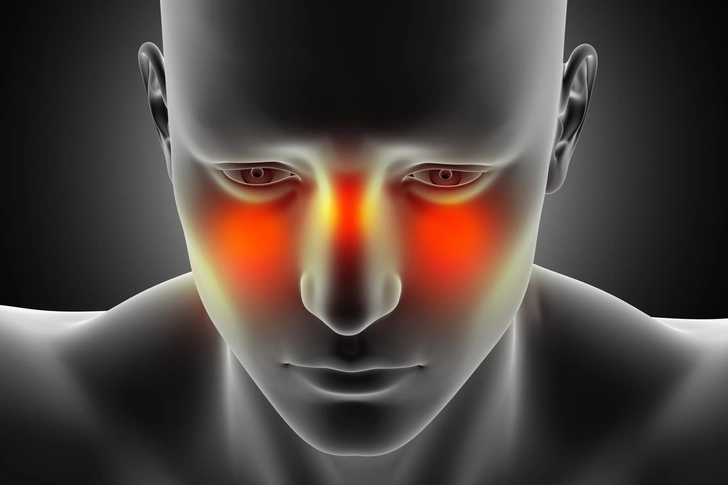 Sinusitis