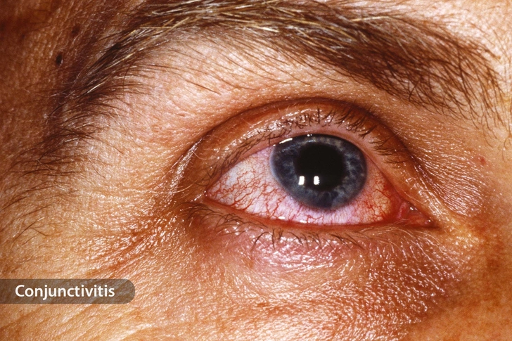 Eye Infection