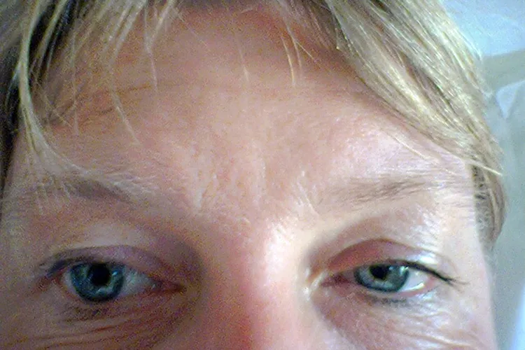 photo of horner's syndrome