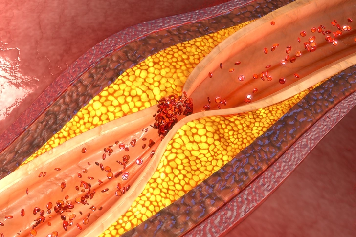 Heart Disease Heart Disease