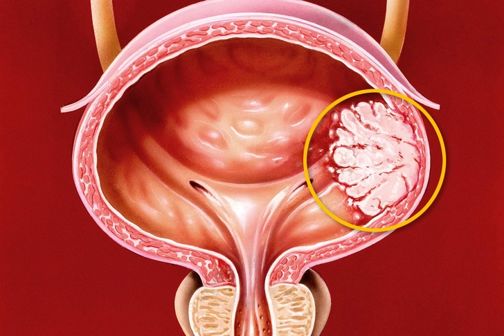 Tumor Tumor