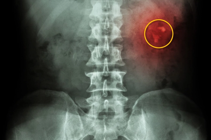 Kidney Stones