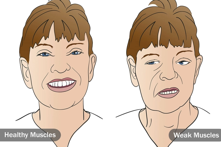 Myasthenia Gravis