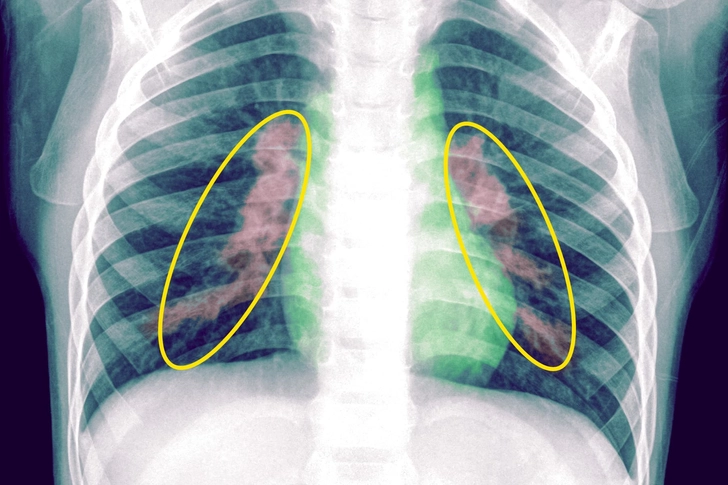 Pneumonia