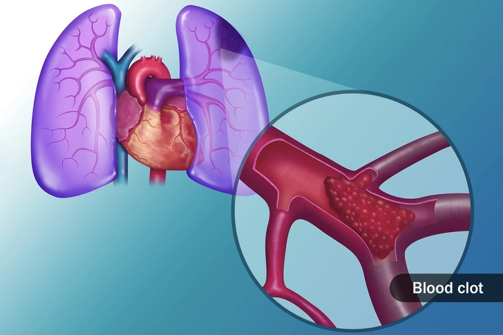 Pulmonary Embolism