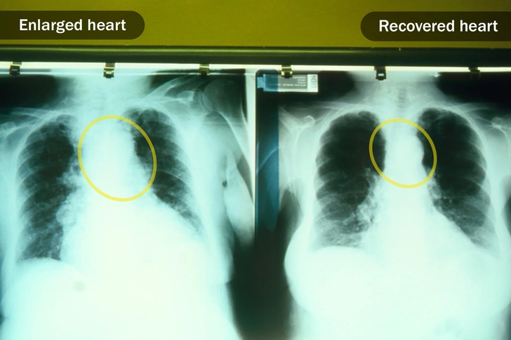 Heart Failure
