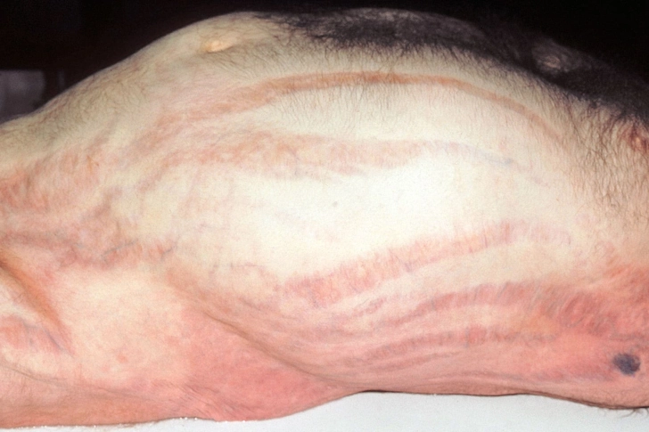 Cushing’s Syndrome