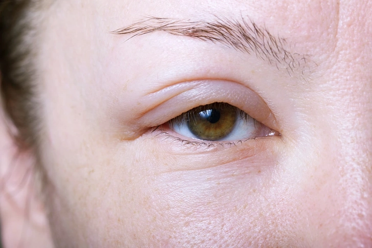 Angioedema
