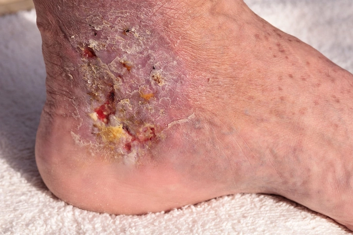 Cellulitis Cellulitis