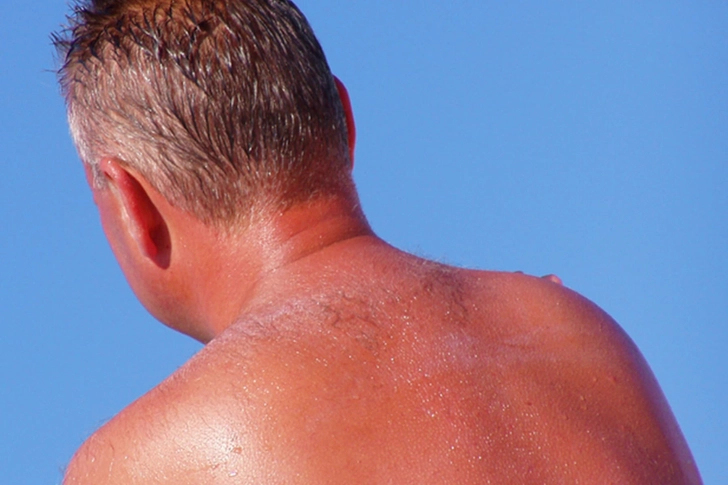 Sunburn