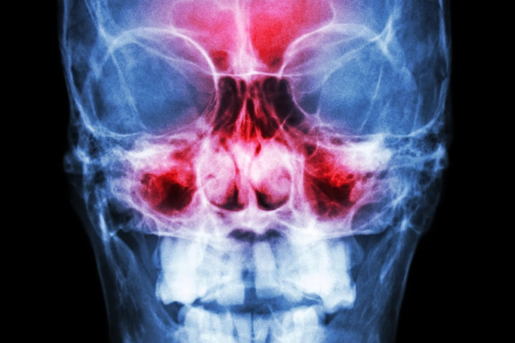 Sinusitis
