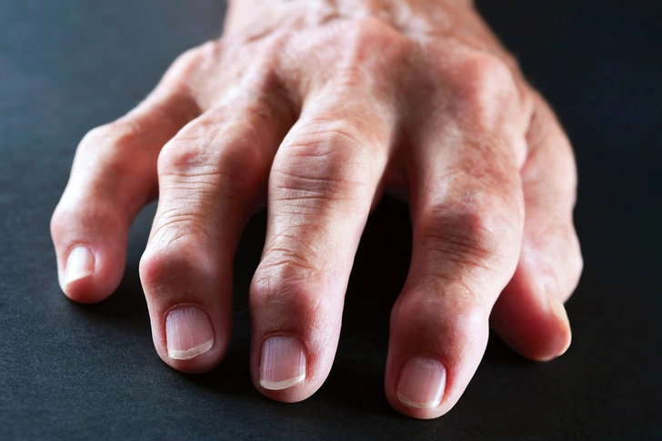 15 Causes of Swollen Fingers