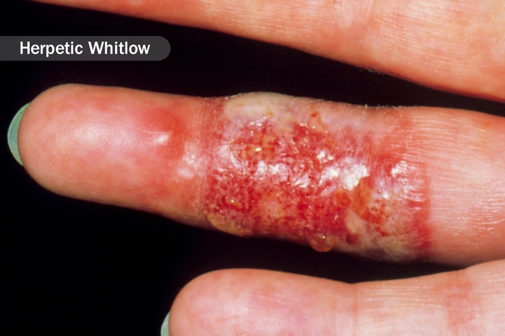 Infections Infections