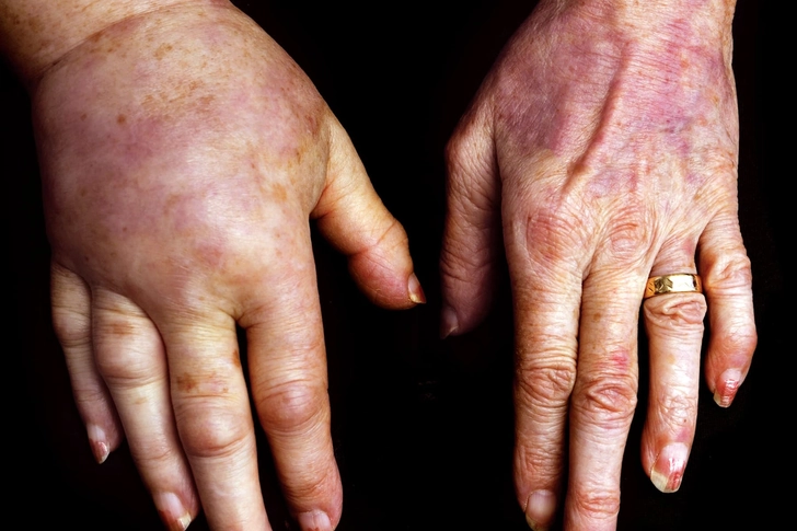 Lymphedema
